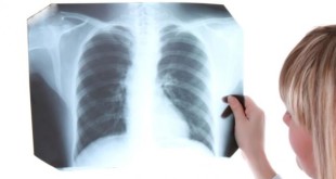 Новый препарат для лечения туберкулеза Бедакилин уже в Грузии, сообщила пресс-служба министерства труда, здравоохранения и социальной защиты.