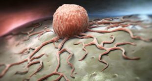 In breast cancer breakthrough, scientists discover targeted delivery of microRNAs to primary tumors blocks the movement of cancer beyond the breast.